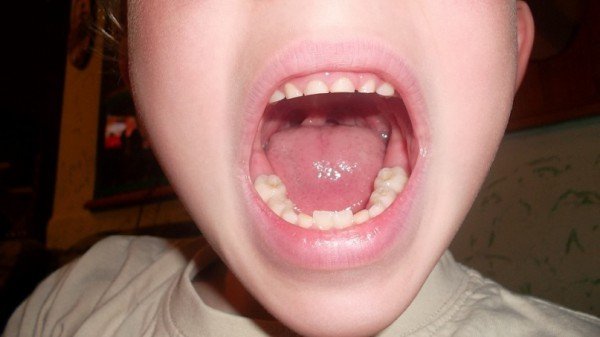  Прорезывание зубов у 6 летнего малыша. 