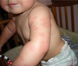 Контактная аллергия фото 