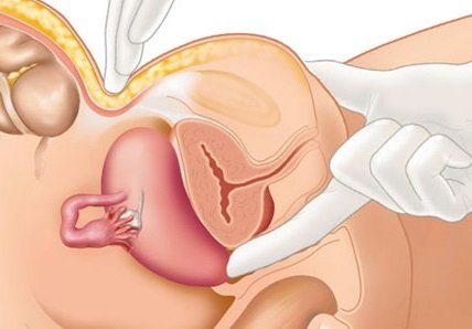 Эндометриоз при беременности 