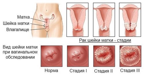 Лечение рака шейки матки 1 стадии фото 