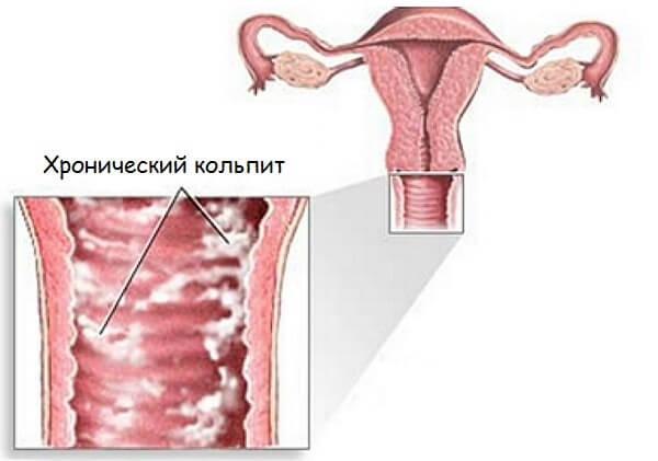 Хронический кольпит до беременности. 