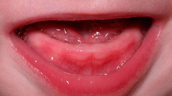 Как облегчить состояние ребенка при прорезывании зубов? 