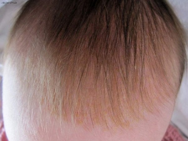 Желтые корочки на голове у новорожденного 