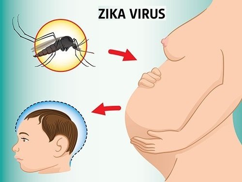 Вирус Зика у беременных вызывает деформацию черепа у плода. 