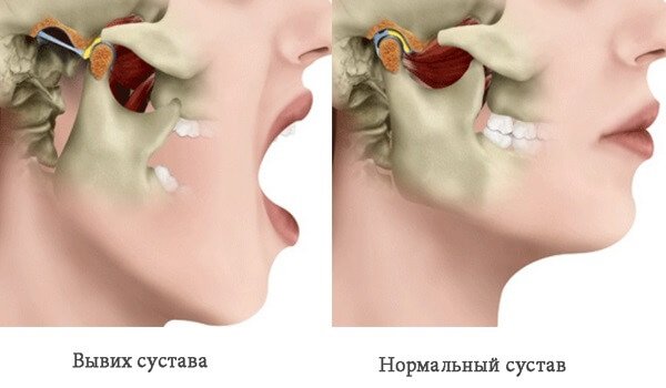 Самые распространенные вывихи суставов - нижняя челюсть. 