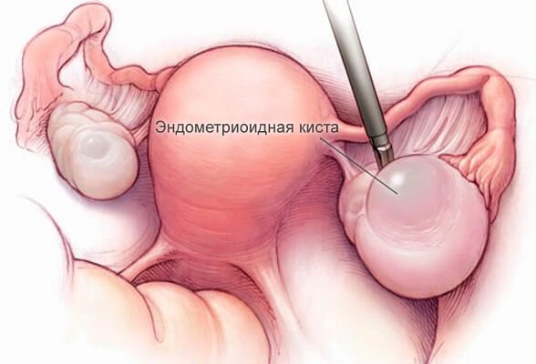 Лечение эндометриоидной кисты яичника без операции. 