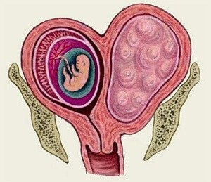 Миома матки при беременности и родах, лечение и последствия. 